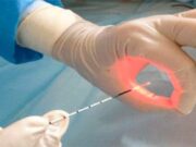 Лазерное иссечение анальной трещины