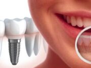 Уход за зубами и ротовой полостью после дентальной имплантации