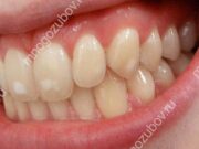 3 опасных причины появления пятен на эмали у взрослых и детей