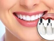 Как долго служат импланты зубов?