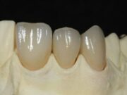 Цельнокерамические коронки emax – красота ваших новых зубов