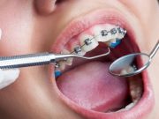 Брекеты: показания и противопоказания к установке