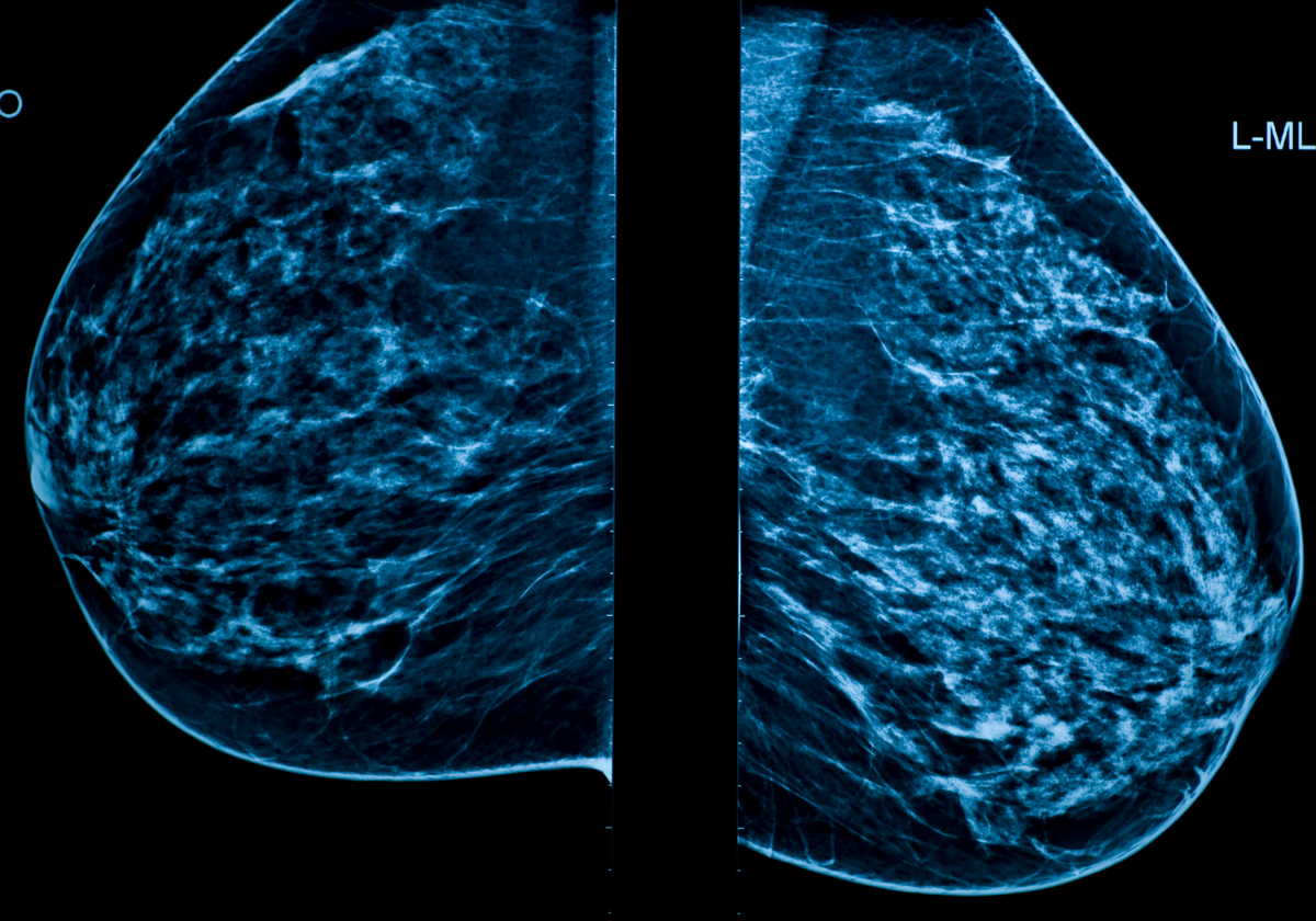 Маммография обязательно. Рентген молочных желез маммография аппарат. Рентгеновский метод маммографии. Томосинтез снимок маммография. Цифровая маммография молочных желез.