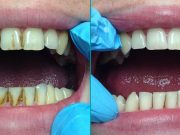 Зачем нужна профессиональная чистка зубов?