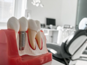 Сколько стоит вставить зуб: полный путеводитель по установке импланта