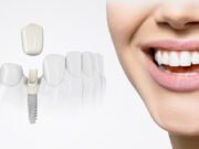 Надежный способ восстановления зубов: имплантация в Сургуте