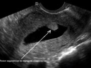 Опасность полипа эндометрия: что нужно знать для сохранения здоровья