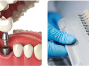 Имплантация зубов за 1 день: технология, преимущества и ограничения