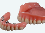 Как подготовиться к имплантации зубов: необходимые обследования и рекомендации