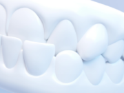 Элайнеры для зубов