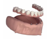 Итальянские имплантаты B&B Dental: надёжный выбор для стоматологических клиник