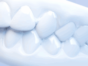 Лечение зубов на брекетах: показания, методы и преимущества