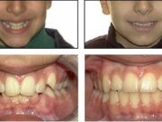 Бруксизм у детей и взрослых: причины, диагностика и современные методы лечения