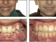 Бруксизм у детей и взрослых: причины, диагностика и современные методы лечения