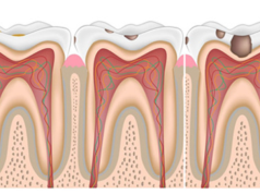 Почему корневые каналы усложняют лечение пульпита?