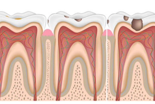 Почему корневые каналы усложняют лечение пульпита?